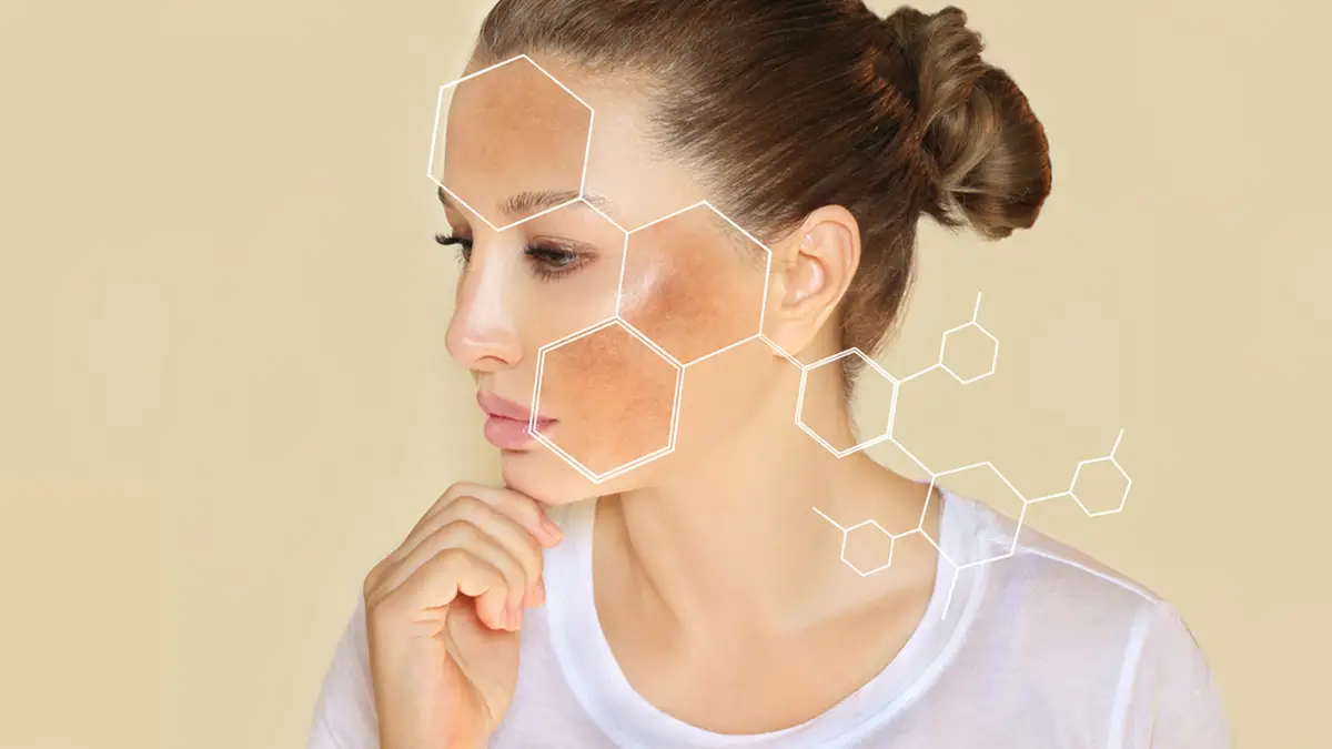 Pigmentflecken entfernen